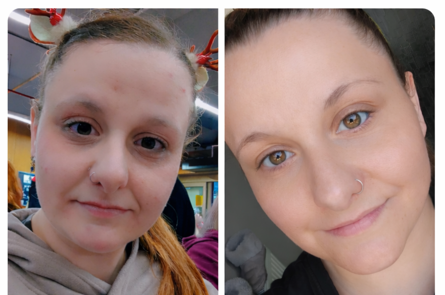 Hannah's skin before and after using NatureGlow Calm and Restore Ritual